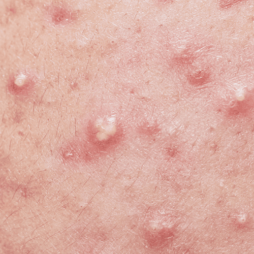Natural Acne Treatment | Vellum Wellness