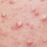 Natural Acne Treatment | Vellum Wellness